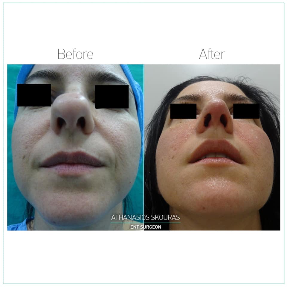 Η κορυφή της ρινός: διόρθωση της τετράγωνης κορυφής με τη Λειτουργική Ρινοπλαστική